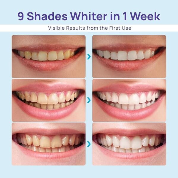 Teeth Whitening Kit for Sensitive Teeth - Image 3